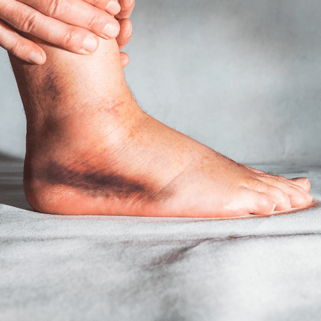 Specialist podiatry treatment for PTTD with orthotics, arch support, and rehabilitation at Foot Foundation