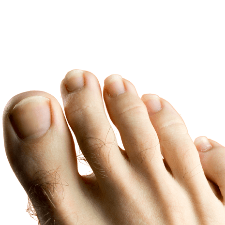 Foot Foundation podiatry treatment for mallet toes with toe-tip offloading, orthotics, and rehabilitation exercises