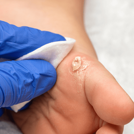 Foot Foundation podiatry treatment for corns and calluses with safe debridement, orthotics, and footwear advice for lasting relief