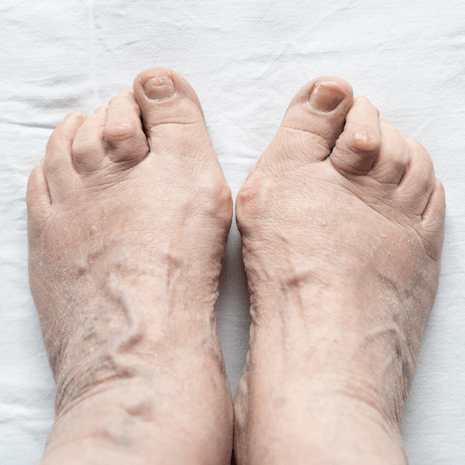 Foot Foundation podiatry treatment for hammer toes with splints, orthotics, footwear advice, and rehabilitation