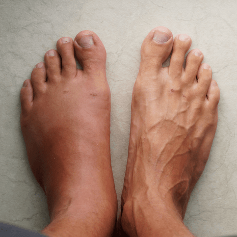 Specialist podiatry and physiotherapy care for leg and ankle nerve entrapment syndromes with orthotics and rehabilitation at Foot Foundation