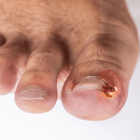 Foot Foundation podiatry treatment for ingrown toenails with conservative care, Onyfix nail bracing, and minor nail surgery