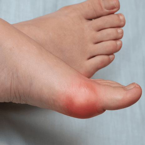 Specialist podiatry care for sesamoiditis and big toe joint pain with orthotics, padding, and rehabilitation at Foot Foundation