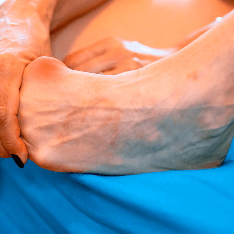 Foot Foundation podiatry treatment for stress fractures in the leg or foot with early diagnosis, orthotics, and rehabilitation support