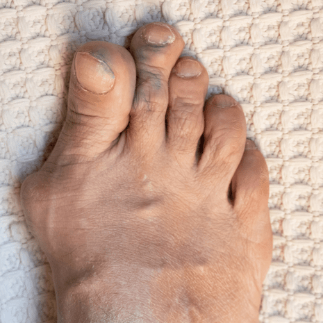 Specialist podiatry care for overlapping toes with separators, orthotics, footwear solutions, and rehabilitation at Foot Foundation