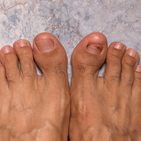 Foot Foundation podiatry treatment for turf toe with stiff-sole protection, orthotics, rehabilitation, and imaging referral