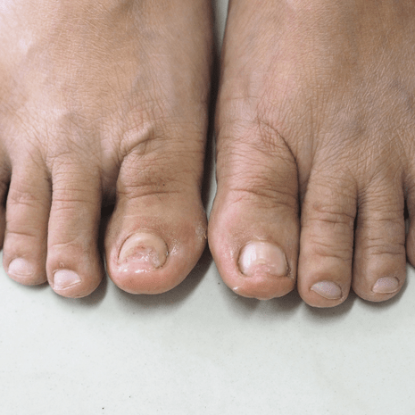 Specialist podiatry treatment for damaged and trauma nails with nail reduction, protection, and surgical options at Foot Foundation