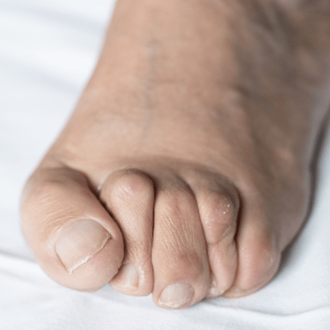 Foot Foundation podiatry care for plantar plate injuries with orthotics, taping, footwear advice, and rehabilitation