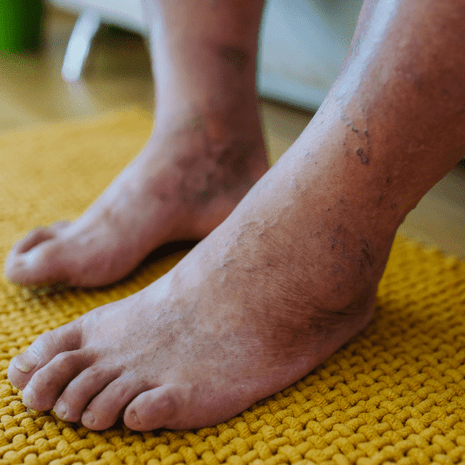 Foot Foundation podiatry care for diabetic foot complications with screening, ulcer prevention, and wound management