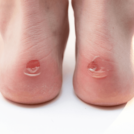 Foot Foundation podiatry treatment for foot blisters with sterile drainage, dressings, and prevention strategies for sport and daily comfort
