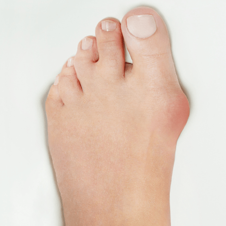 Foot Foundation podiatry treatment for bunions and hallux valgus with orthotics, footwear advice, and rehabilitation