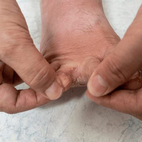 Foot Foundation podiatry care for athlete’s foot with antifungal treatment, footwear advice, and hygiene strategies to stop reinfection