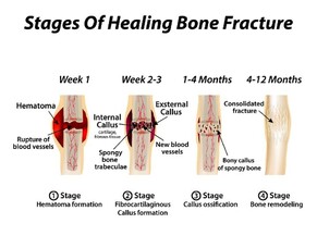 BROKEN ARM OR LEG - WHAT CAN I DO TO HELP MY RECOVERY?