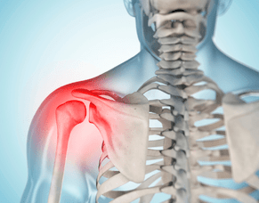Good research on supraspinatus tear treatment vs surgery