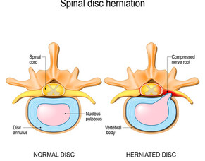 Sciatica and Back Pain