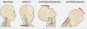 WHIPLASH INJURY AND OSTEOPATHIC MANUAL TREATMENT.