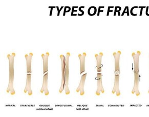 Bone Injuries and their Healing