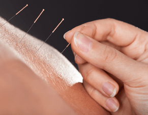 Acupuncture Myths Sorted