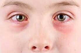 Eye Allergies