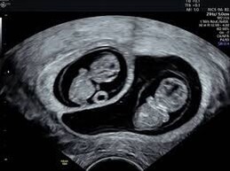 EXPECTING MULTIPLES?