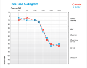 What is an Audiogram?