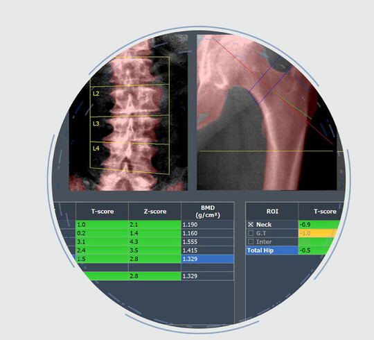 DEXA Scan - Scores & Everything You Need to Know