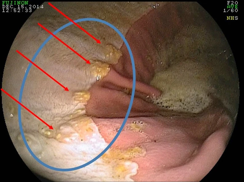 Gastric ulcer-related pain
