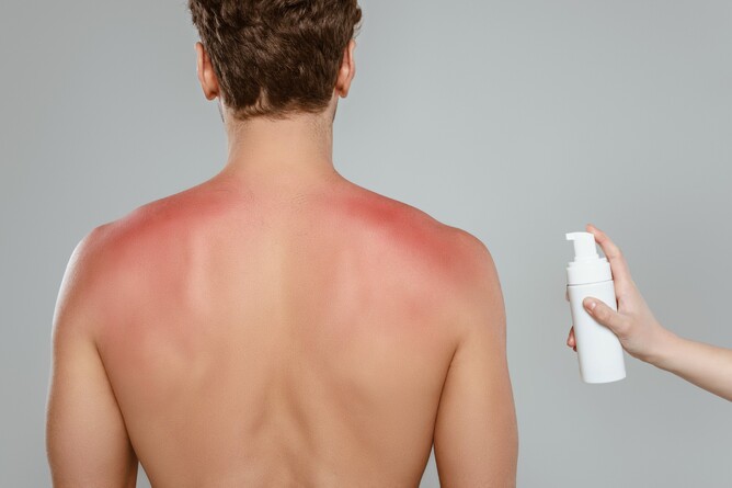 Person applying sun burn aftercare products on someone with sunburn