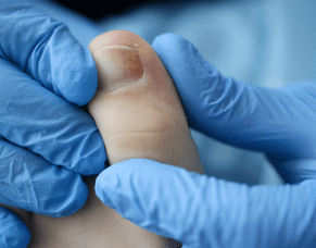 Ingrown toenail surgery