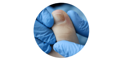 Ingrown Toenails