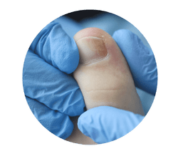Ingrown Toenails