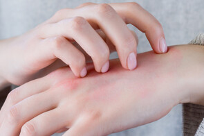 Scabies