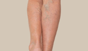 Bruising & Varicose Veins