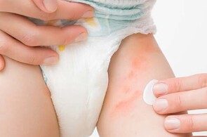 Nappy Rash