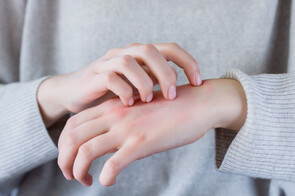 Scabies