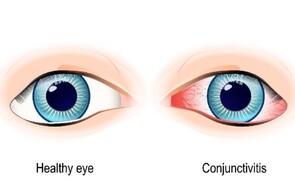 Dry Eyes