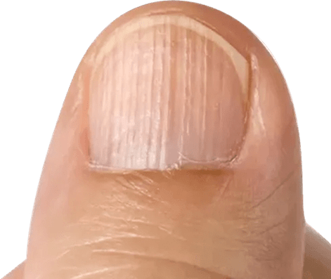 Terrys Nails Is Leukonychia Characterized By Opacification White Most Nail  Missing Lunula And A Narrow Band Of Red Of Brown At Tip Stock Photo -  Download Image Now - iStock