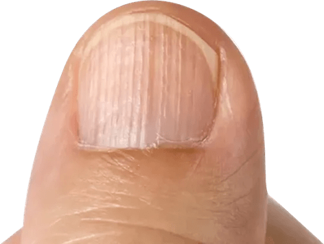 Ridged Nails | Cosmetic Nail Solutions