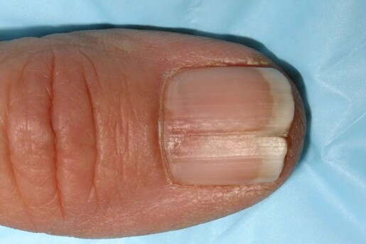 Do you have certain nails that grow way better thN others? My ring finger  nails are pretty strong, but my pointer and middle finger nails break and  peel all the time. :
