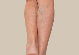 Bruising & Varicose Veins