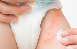 Nappy Rash