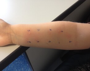 Skin Prick Testing &ndash; What is it?