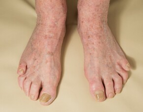 Fungal Nails - Or Something Else? Don&rsquo;t Waste Time Treating The Wrong Problem