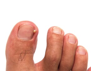 OnyFix: NZ&rsquo;s #1 Painless Ingrown Toenail Treatment