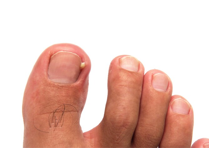 Ingrown toenails - Diagnosis & treatment - Mayo Clinic