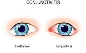 Eye Infections