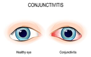 Eye Infections