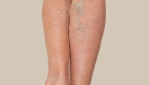 Bruising & Varicose Veins