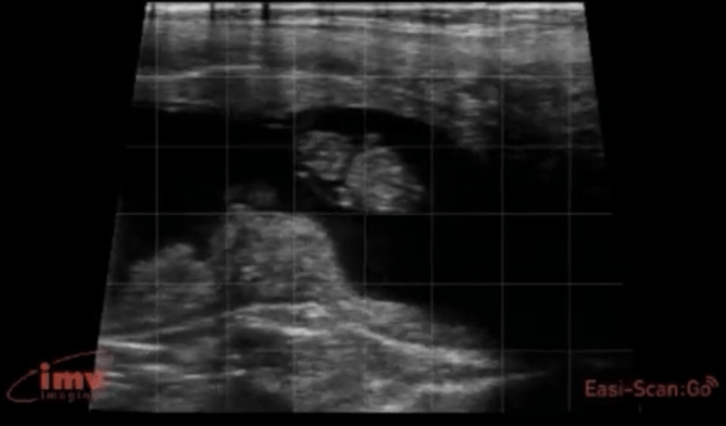 A 39-day-old foetus. It’s small, grey and almost peanut shaped, surrounded by black. It’s quite small and easy to measure at this stage.