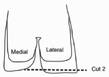 Figure 2. Line shows the cut that will level the toes as described in Step 2. Outer claw is called lateral, inner claw is called medial. 